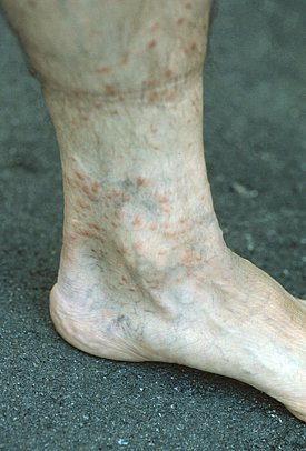 Nahaufnahme eines Fusses und Knöchels mit sichtbaren Hautveränderungen, darunter Rötungen und kleine Beulen. Der Fuss liegt auf einem rauen, dunklen Untergrund.